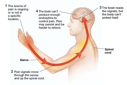 nerve pain nerve pain
